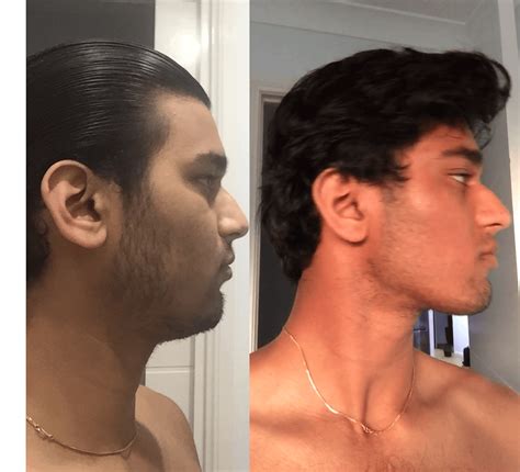 19M 4 Month Mewing 2 Month Chewing Mastic Gum Progress R Mewing