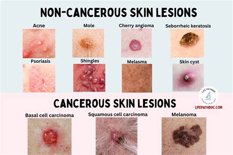 20 Types Of Skin Lesions Causes And Pictures