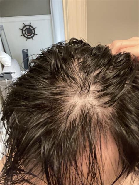 3 Years Hair Loss R Telogeneffluvium