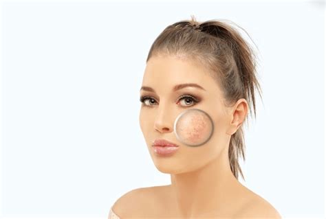 4 Broken Capillaries Cheeks Royalty Free Images Stock Photos