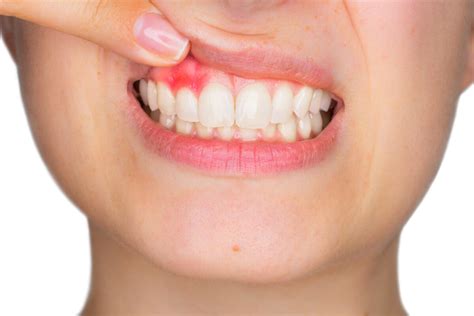 5 Ways To Prevent Bleeding Gums When Brushing Decobizz Lifestyle Blog