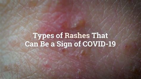 8 Types Of Rashes That Can Be A Sign Of Covid 19