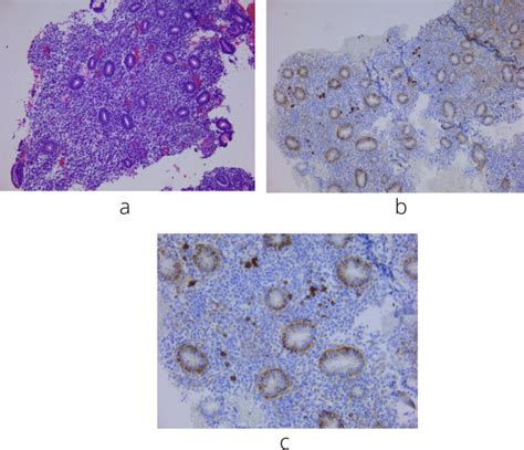 A Fragment Of The Endometrial Mucosa Showing Proliferative Endometrial