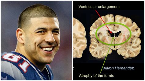 Aaron Hernandez S Cte 5 Facts About This Brain Disease Artofit