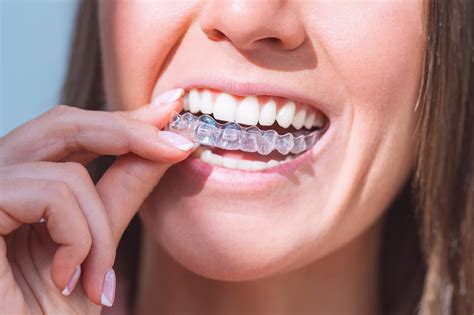 Accepted Insurance Top Orthodontist Braces Clear Aligners