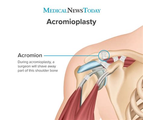 Acromioplasty Definition Of Acromioplasty By Medical Dictionary