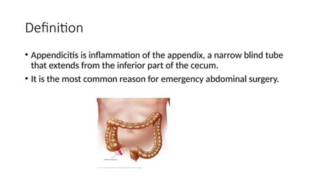 Acute Appendicitis Clinical Features Management Teachmesurgery