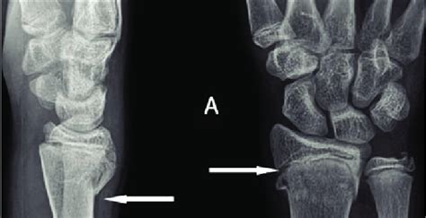 Acute Buckle Fracture Wrist Trailshery