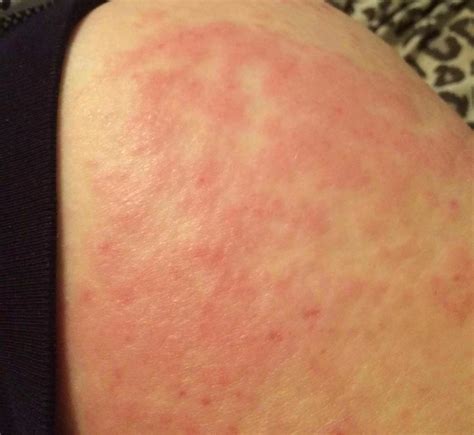 Albums 90 Pictures Pictures Of Gluten Allergy Rash Full Hd 2K 4K