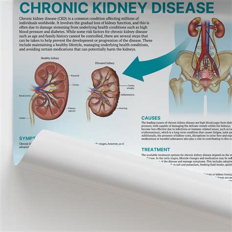 All About Chronic Kidney Disease Vrogue Co