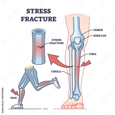 All About Stress Fractures
