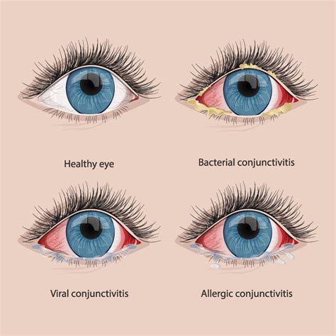 Allergic Conjunctivitis Discharge
