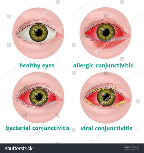 Allergic Conjunctivitis Vs Bacterial Conjunctivitis