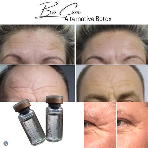 Alternative To Botox