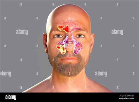 Anatomy Of Sinus Infection