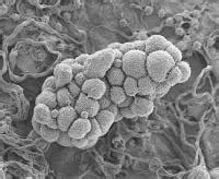 Anti Leukemia Drug May Also Work Against Ovarian Cancer