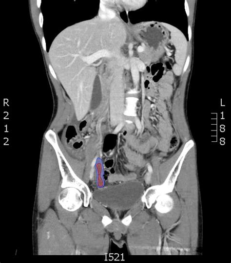 Appendicitis Ct Scan