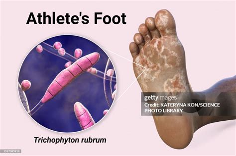 Athlete Amp 39 S Foot Fungus Artwork Stock Image C020 4457 Science