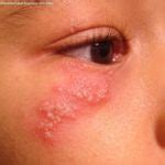 Atopic Dermatitis North West Allergy Network