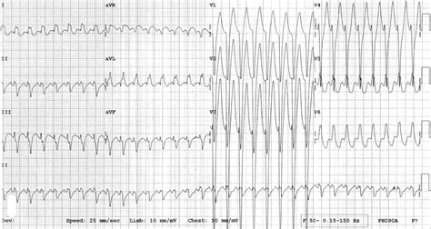 Atrioventricular Re Entry Tachycardia Avrt Litfl Ecg Library
