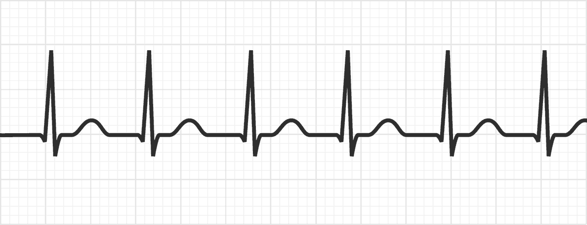 Av Nodal Reentrant Tachycardia Avnrt Ecg Example 3 Le Vrogue Co