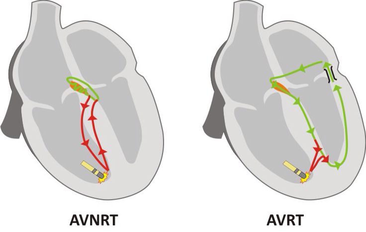 Avrt Vs Avnrt R Ekgs