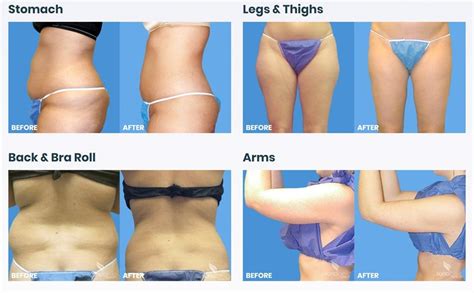 Awake Micro Laser Liposuction Procedure Live Trisculpt Fat Removal