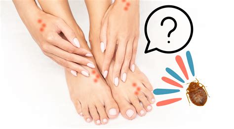Bed Bug Bites Feet At Declan Thwaites Blog