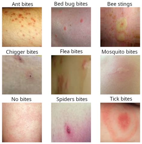 Bed Bug Bites In Toronto Pest Control Of Bed Bugs Fleas And Cockroaches