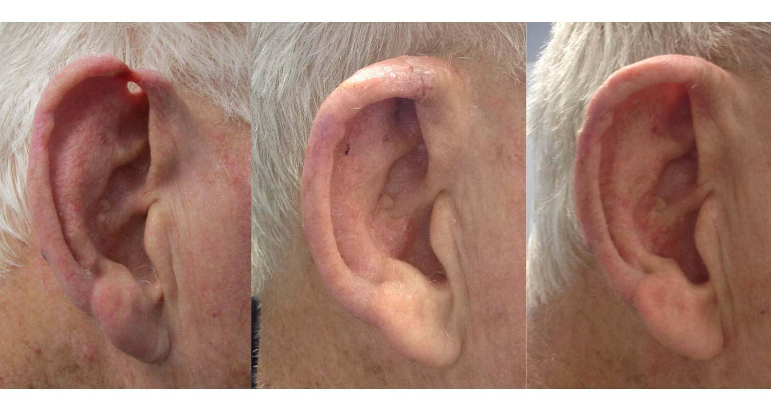 Before After Photos Dermassociates Silver Spring