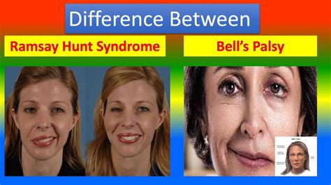 Bell S Palsy And Ramsay Hunt Syndrome Tampa Bay Hearing And Balance
