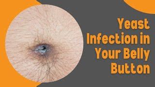Belly Button Yeast Infection Photos