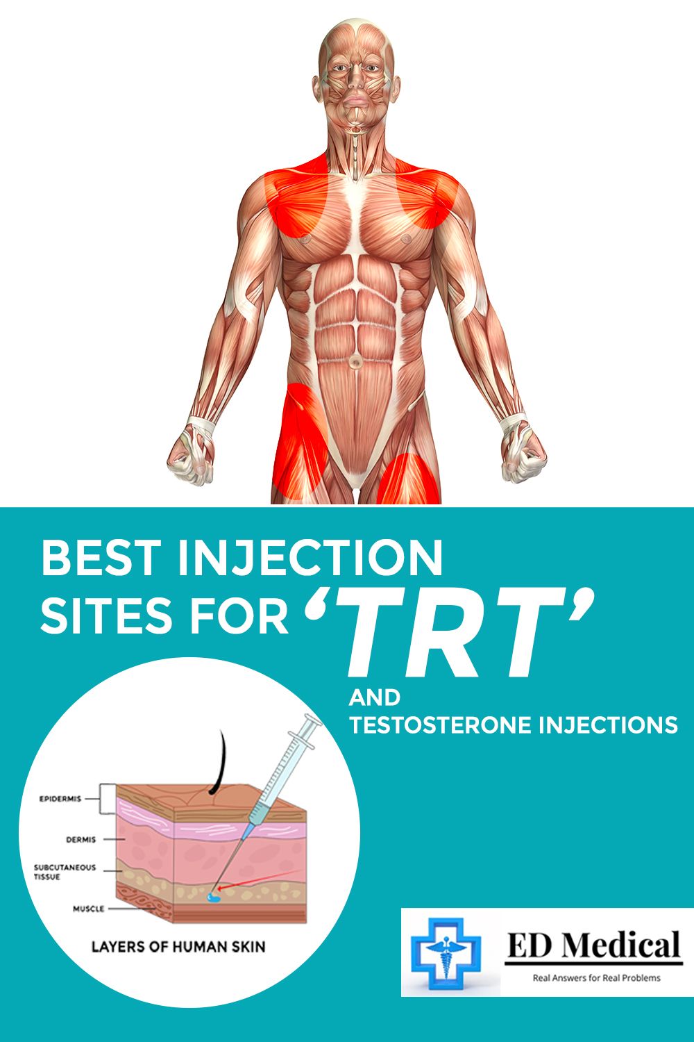 Best Injection Sites For Trt And Testosterone Injections Artofit