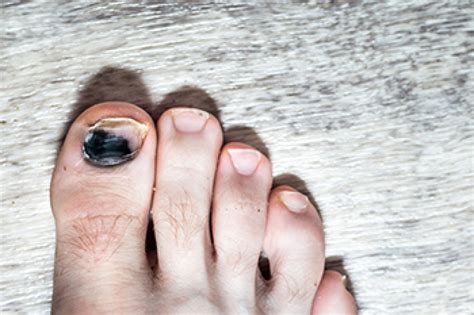 Black Toenail 5 Common Causes And Treatment A Helpful Guide