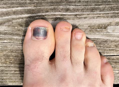Black Toenail Treatment Causes Prevention