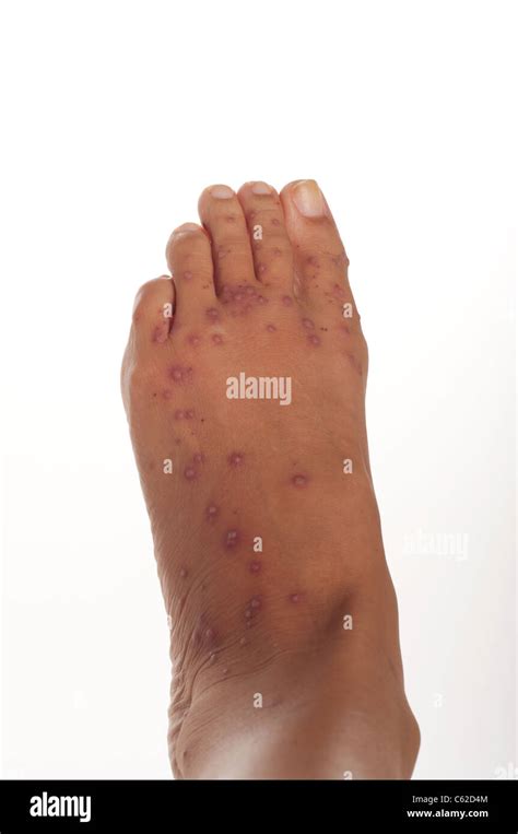 Blisters On A Foot Caused By Fire Ant Bites Shot In The Studio On A