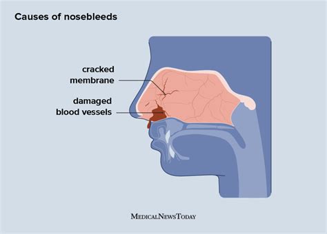 Bloody Mucus In Nose