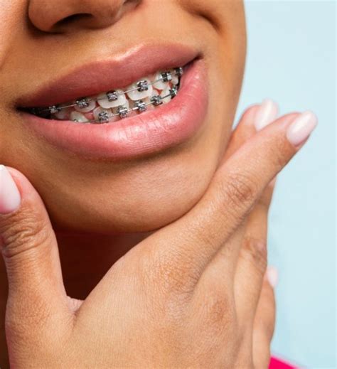 Braces Covered By Medicaid Mcallen Texas Orthodontist
