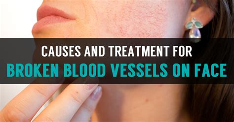 Broken Blood Vessels On Face