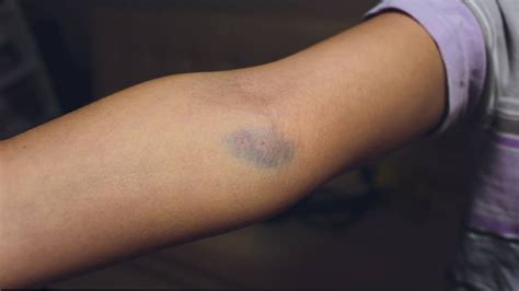 Bruising From Post Blood Draw Injections Is It Dangerous