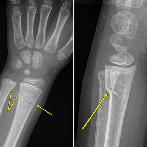 Buckle Fracture Wrist