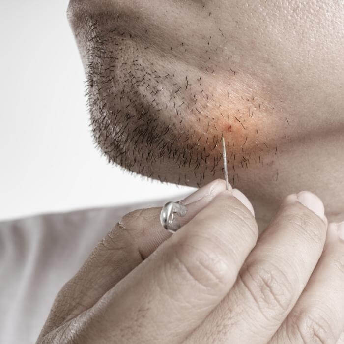 Bump On My Neck Ingrown Hair R Medical