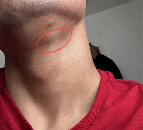 Bump On Neck