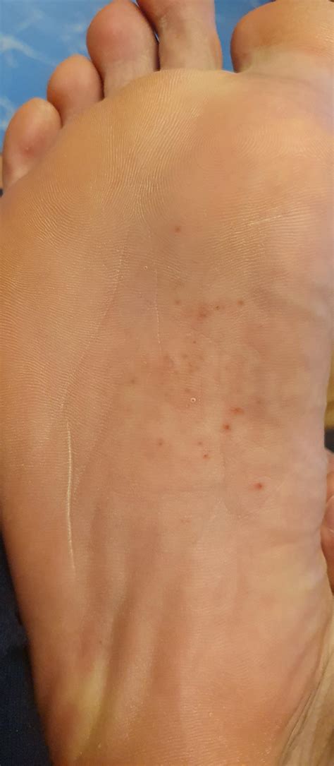 Bumps On Bottom Of Feet Red White Small Painful Hurt That Itch