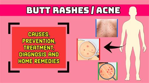 Butt Rashes I Prevention Treatment Home Remedies Pain Relief I