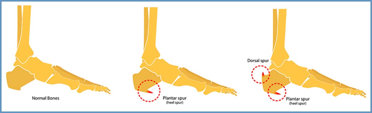 Calcaneal Osteotomy Heel Bone Spur Yellowstone Surgery Center