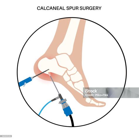 Calcaneal Spur Surgery