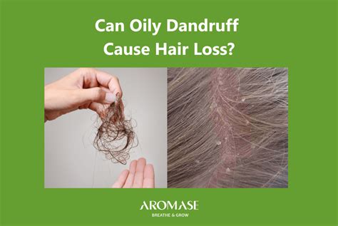 Can Dandruff Cause Hair Loss