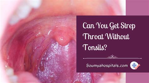Can You Get Strep Throat Without Tonsils Wapomu Health Wellness