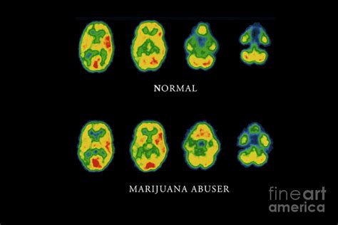 Cannabis Brain Scans Photograph By Pascal Goetgheluck Science Photo
